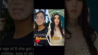 aastha shah transformationaastha shah before and after vitiligo shorts [upl. by Aanas870]