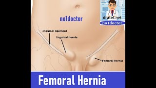 Femoral HerniaFemoral Canal Anatomy Groin HerniaInguinal Hernia SurgeryLap Hernia surgery [upl. by Twedy]