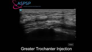 Ultrasound Guided Greater Trochanteric Bursa Injection [upl. by Epilihp541]