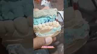 Zirconia bridge viralvideozirconiashortvideo [upl. by Esilrac]