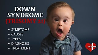 What is Down Syndrome Trisomy 21 Down syndrome Trisomy 21 Made Easy [upl. by Diao]