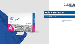 Multiple recession with Geistlich Mucograft® [upl. by Stephani]