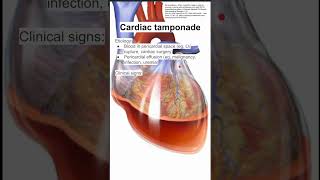 Cardiac tamponade [upl. by Akimit]