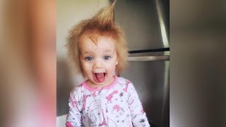 Childs Uncombable Hair Syndrome Explained [upl. by Groark743]