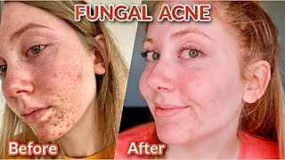 FUNGAL ACNE  How I Knew I had it  How I cleared it  Signs of fungal acne and products to use [upl. by Hakeber]