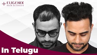 Best Hair Transplant in Hyderabad  Eugenix Hair Sciences [upl. by Netsrijk654]