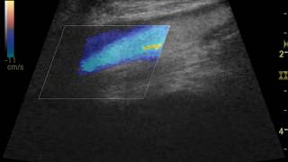 Vascular Ultrasound [upl. by Akinom785]