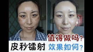 PicoSure Laser Review  BeforeampAfter皮秒镭射体验＋前后对比MsLindaY [upl. by Ailaro]