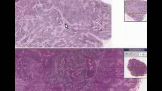 Histopathology Lymph node Anthracosis [upl. by Kory]