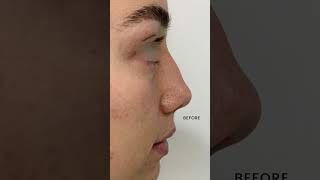 Non Surgical Rhinoplasty Results [upl. by Fortna]