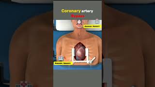 coronary artery bypass graft animation।।पोस्टमार्टम heart humanbodyshorts [upl. by Gunas]