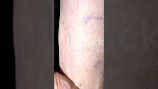 Varicose veins varicose vein what medical educational [upl. by Einnaoj]