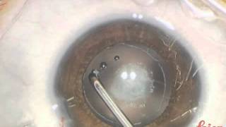 anterior capsulotomy by radiofrequency diathermy in pediatric cataract surgery [upl. by Ahsayn585]