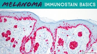 Melanoma Immunohistochemistry Basics Melanoma In Situ vs Solar Lentigo  5Minute Pathology Pearls [upl. by Ailaro]