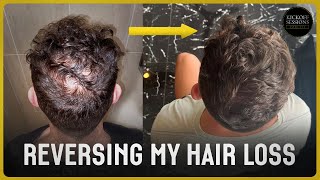 How I Reversed My Hair Loss  1 Year Transformation  NO HAIR TRANSPLANT [upl. by Eilrahs]