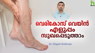 വെരികോസ് വെയിൻ കാരണങ്ങളും ചികിത്സയും  Varicose veins Malayalam Health Tips  Arogyam [upl. by Saraiya]