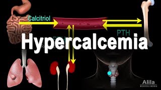 Hypercalcemia  Too Much Calcium Animation [upl. by Mort640]