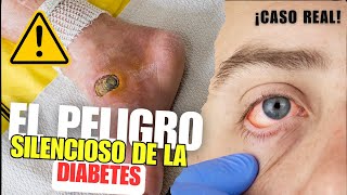 Caso Real Los Efectos Devastadores de la Diabetes en el Cuerpo [upl. by Thissa]