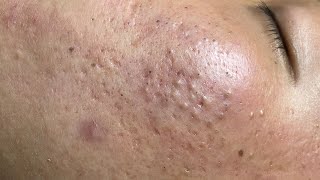 ACNE TREATMENT VU QUYNH MI  Blackheads On Boy Face 2024FULL [upl. by Johnath520]