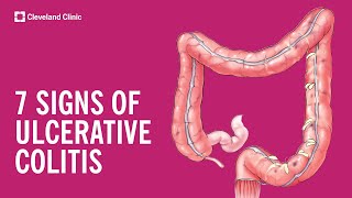 7 Warning Signs of Ulcerative Colitis [upl. by Proudman665]