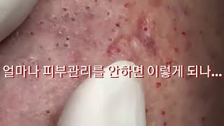 피부관리를 얼마나 안했길래여드름피지고름blackheadwhiteheadニキビ [upl. by Onitnatsnoc]