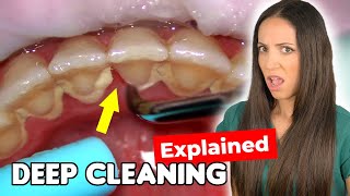 Dental Hygienist Explains Deep Cleaning Procedure [upl. by Newol839]