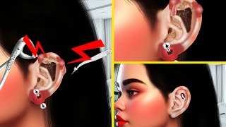 ASMR Infected Ear Piercing Treatment Animation  ASMR Ear Pus Removal Animation  ASMR Derm [upl. by Teteak]