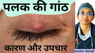 पलक मे गांठ  लक्षण कारण इलाज Home Remedies Chalazion Eyelid Cyst Doctor Sonal [upl. by Nednil]