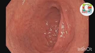 Candida oesophagitis l l Endo Cut [upl. by Kina]