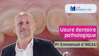 Formation Elearning DPC  Usure dentaire pathologique [upl. by Dera]