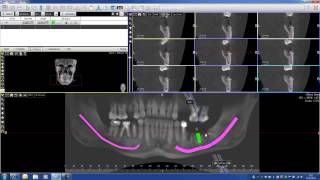 Implant PLanning with Acteon Imaging Suite CBCT Cone Beam part 2 [upl. by Gracye]