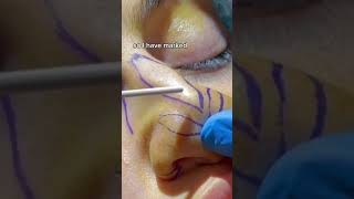 RHINOPLASTY STEPBYSTEP DR TANVEER JANJUA NEW JERSEY [upl. by Ogawa435]