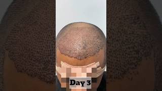 Hair Transplant Days till Scab Removal How long scabbing is seen [upl. by Bernadine]