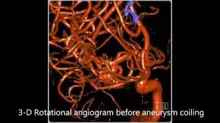 RIGHT MCA BIFURCATION ANEURYSM COILING [upl. by Luanni]