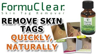 FORMUCLEAR Skin Tag Remover [upl. by Tsew]