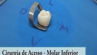 Molar Inferior  Cirurgia de Acesso [upl. by Enelyar388]