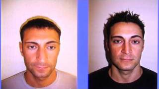 Male Rhinoplasty NYC [upl. by Penhall]