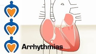 Arrhythmias  What is an arrhythmia and how is it treated [upl. by Olmsted552]