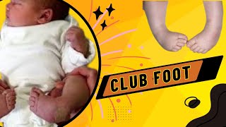 Talipes Equinovarus  Club Foot  Causes Symptoms Diagnosis and Treatment [upl. by Kitti]