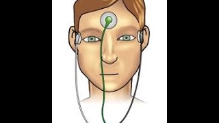 EOG Electrooculogram [upl. by Aicena]