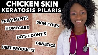 Keratosis Pilaris Chicken Skin  Treating Dry Bumpy Skin  Special Tips for Black Skin  Ask Doctor [upl. by Uahsoj92]