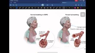 شرح باطنية COPD [upl. by Anoblav]