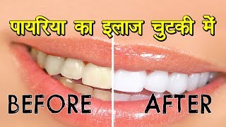 पायरिया का इलाज चुटकी में  How to Cure Pyria and all dental problems  Health Vatika [upl. by Notffilc]