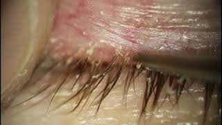 Demodex Blepharitis Eyelash Debriding  Thick Lashes [upl. by Hplar]