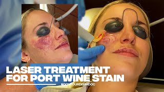 Treating a PortWine Stain with Excel V Laser at Contour Dermatology [upl. by Sioux274]