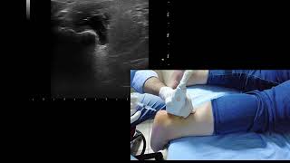 Ultrasound guided retrocalcaneal bursitis and achilles tendinitis injection [upl. by Enram537]