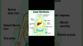 Liver cirrhosis is a chronic condition characterized by the replacement of healthyliver liverdamage [upl. by Aerised]