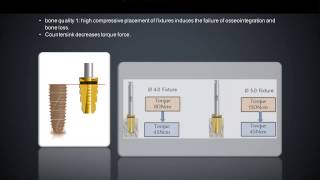 INNO implant surgical protocol [upl. by Crosley]