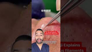 sebaceous filaments nose extraction  Dr MediSpa [upl. by Yaresed]