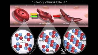 Viviendo con Drepanocitosis [upl. by Finn]